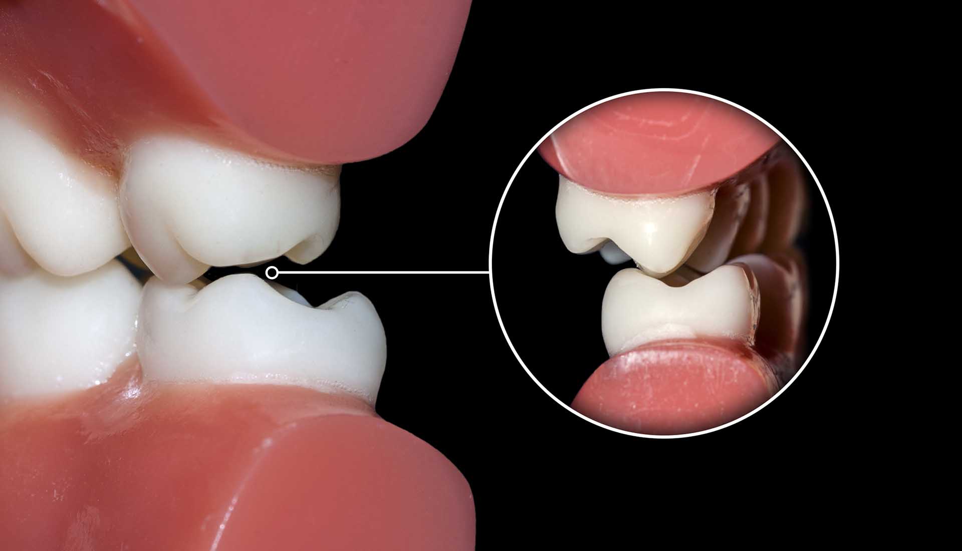 Dantų griežimo pavojus: priežastys, poveikis ir gydymo būdai.